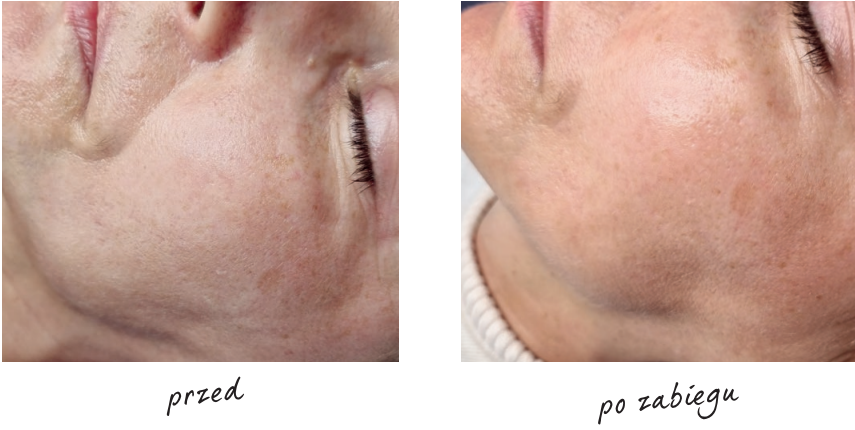Endermologia efekty przed i po 1