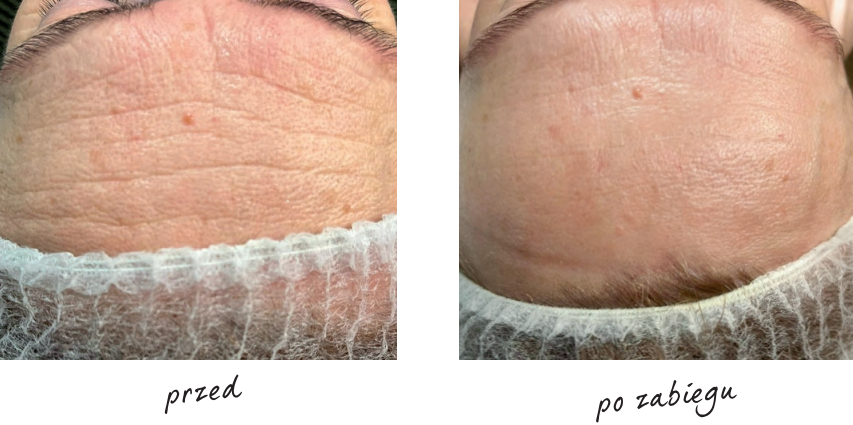 Endermologia efekty przed i po 2