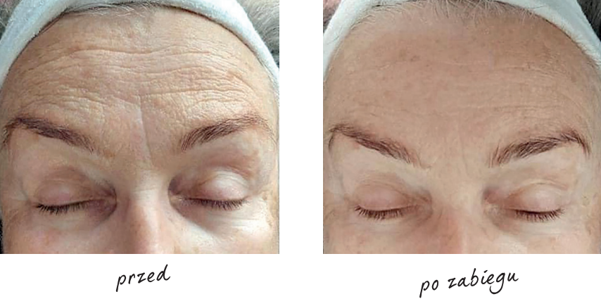 Endermologia efekty przed i po 3