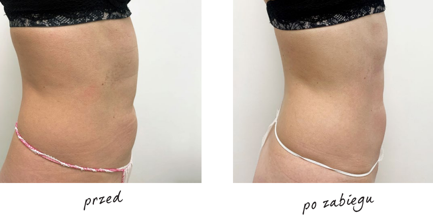 Endermologia efekty przed i po 4