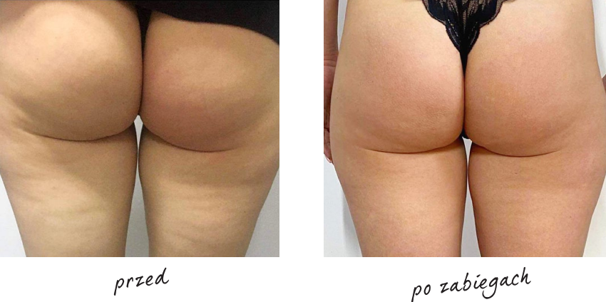 Endermologia efekty przed i po 5