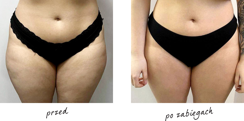 Endermologia efekty przed i po 6