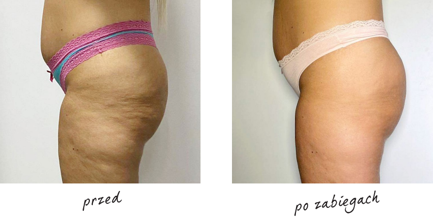 Endermologia efekty przed i po 7