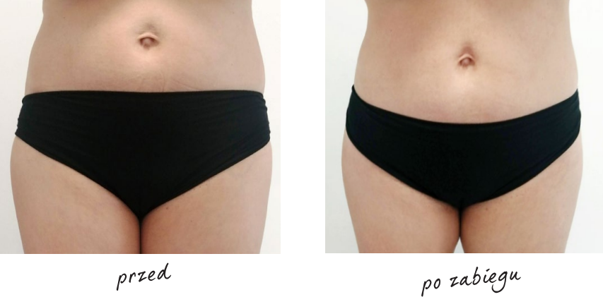 Endermologia efekty przed i po 8
