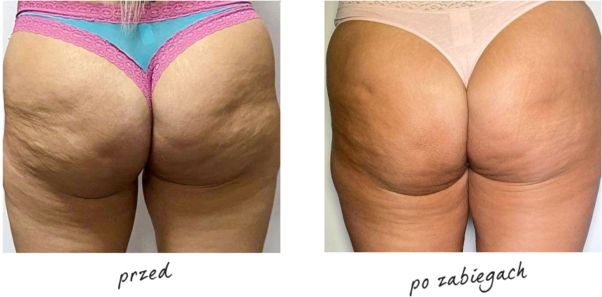 Endermologia efekty przed i po 9