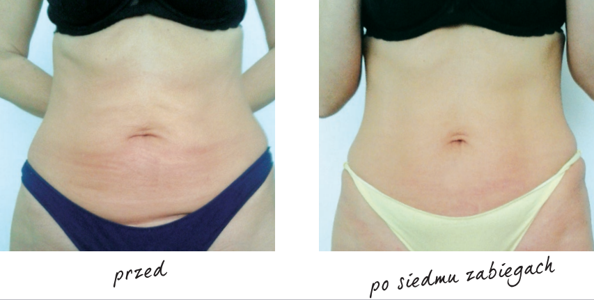 Endermologia efekty przed i po 10