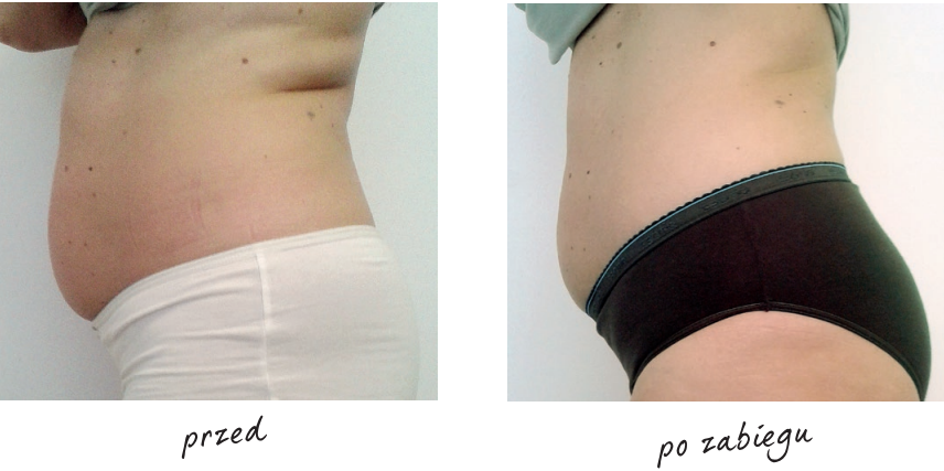 Endermologia efekty przed i po 11