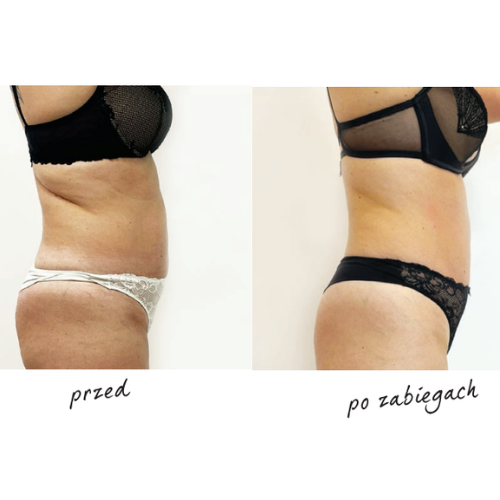 Metamorfoza przed i po zabiegach endermologii